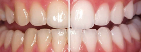 Teeth Whitening Just In Time For Summer!