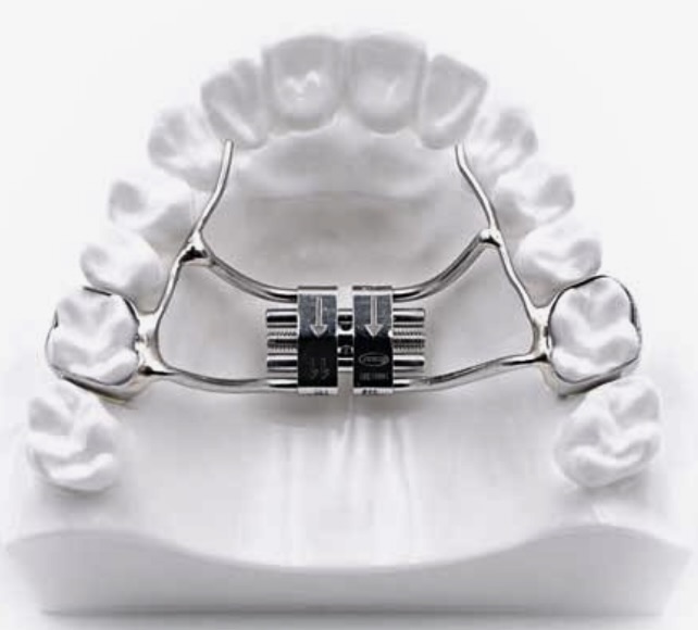 What is an Expander? Fresh Smiles Orthodontics